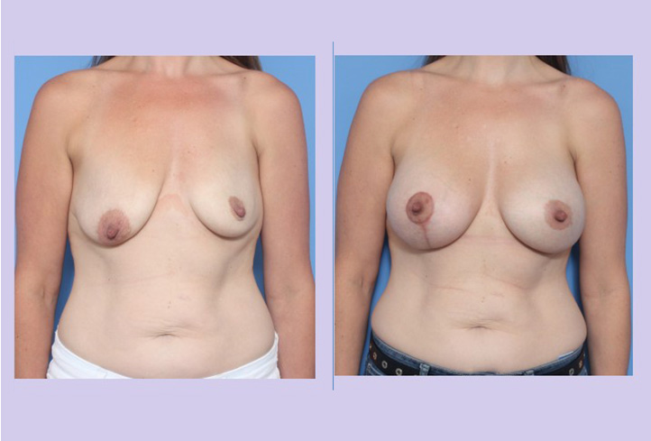 Before and After Image: Breast Lift- Case 21 - front