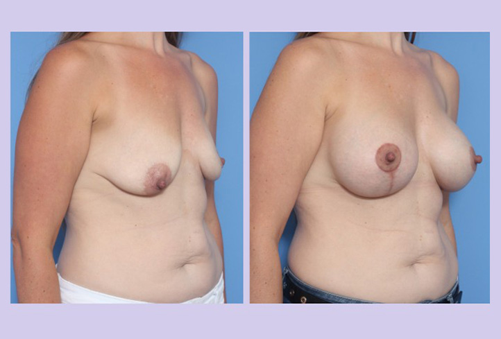 Before and After Image: Breast Correction  – Case 21 - front