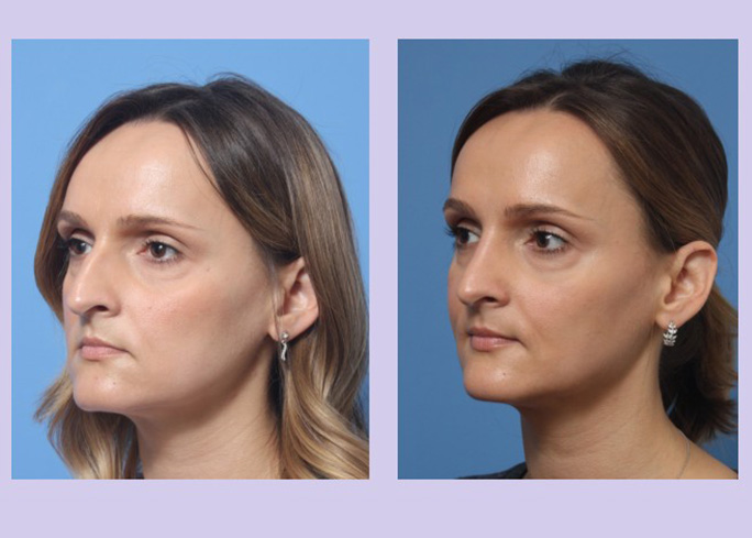 Before and After Image: Rhinoplasty – Case 8 - left-front-oblique