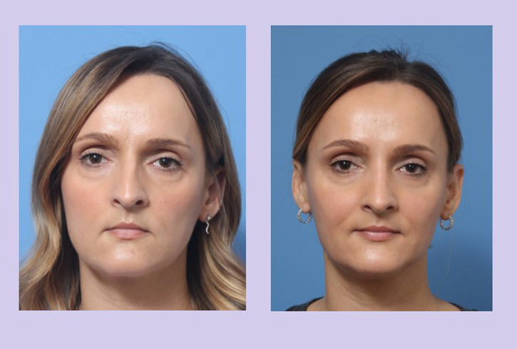 Before and After Image: Rhinoplasty – Case 8 - front