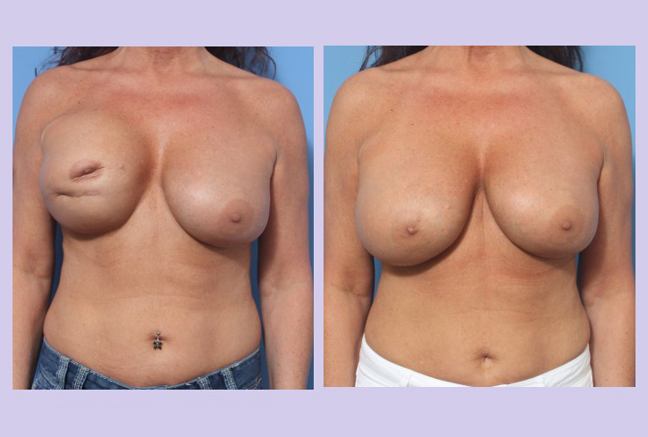 Before and After Image: Breast Correction – Case 22 - front