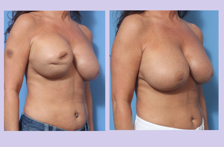 Before and After Image: Breast Correction – Case 22 - right-front-oblique