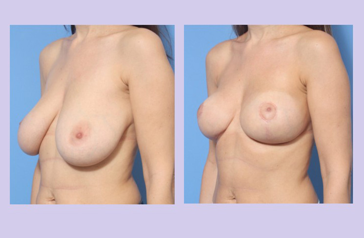 Before and After Image: Breast Lift – Case 22 - left-front-oblique