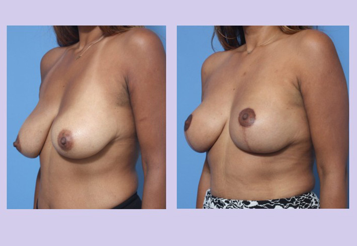 Before and After Image: Breast Lift – Case 23 - left-front-oblique