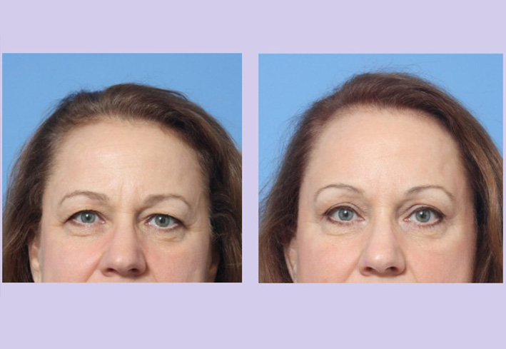 Before and After Image: Upper Blepharoplasty – Case 36 - front