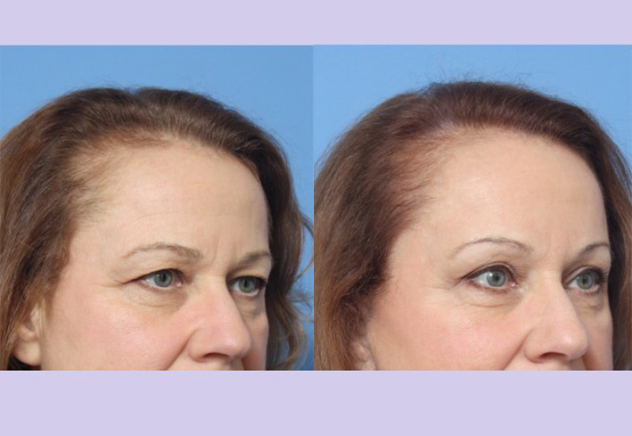 Before and After Image: Browlift – Case 7 - other