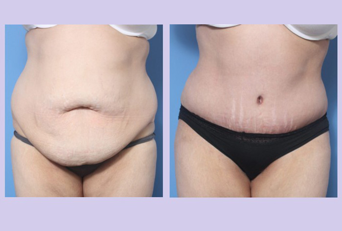 Before and After Image: Abdominoplasty – Tummy Tuck – Case 34 - front