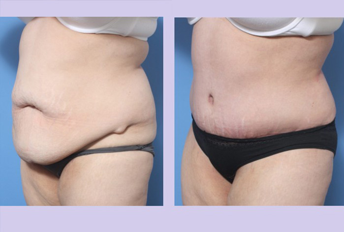 Before and After Image: Abdominoplasty – Tummy Tuck – Case 34 - left-front-oblique