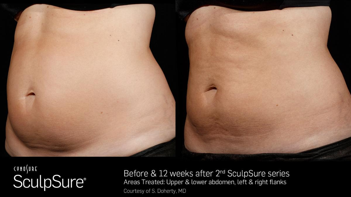 SculpSure
