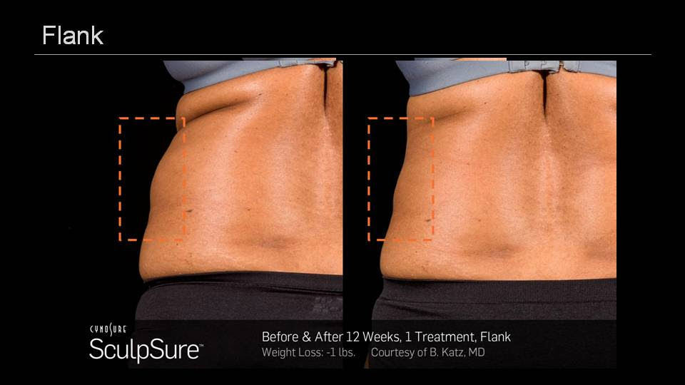SculpSure