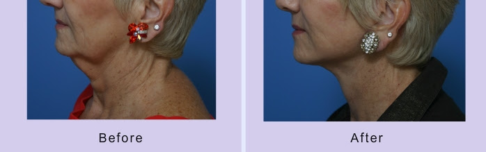 Face Lift