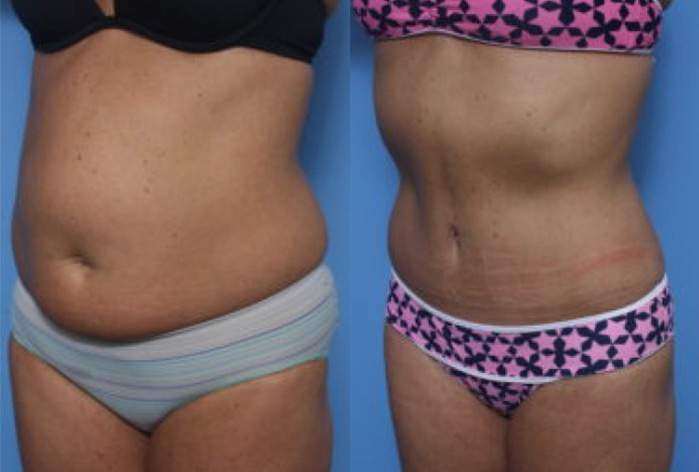 Before and After Image: Abdominoplasty- Tummy Tuck – Case 35 - left-front-oblique