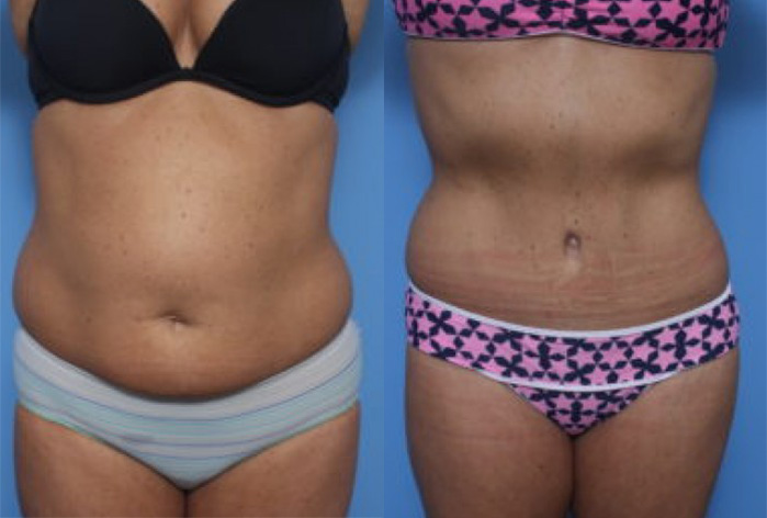 Before and After Image: Abdominoplasty- Tummy Tuck – Case 35 - front