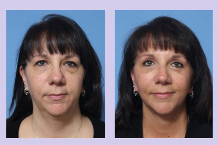 Before and After Image: Upper and Lower Blepharoplasty – Case 38 - front