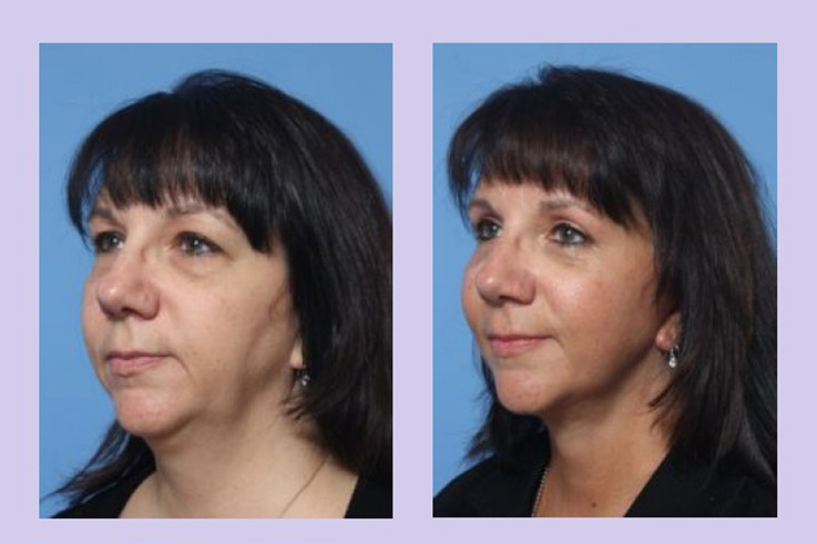 Before and After Image: Lower Facelift- Case 23 - left-front-oblique