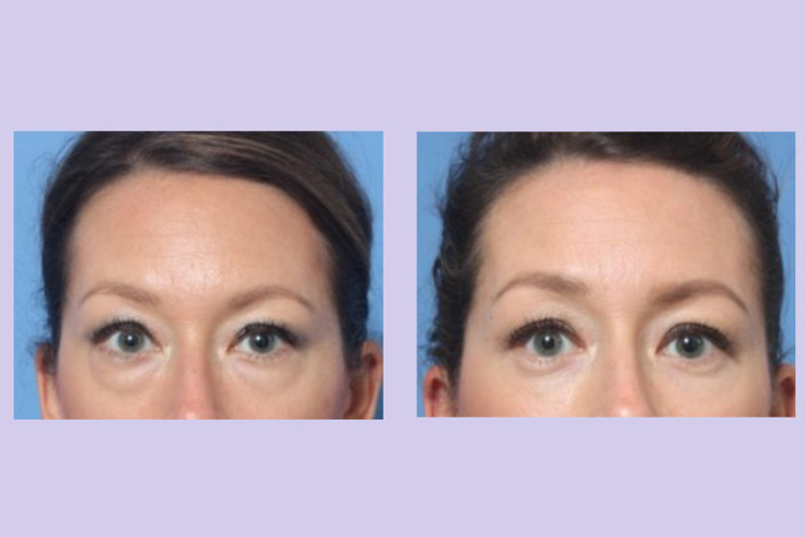 Before and After Image: Lower Blepharoplasty – Case 37 - front