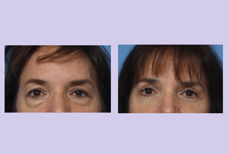 Before and After Image: Upper and Lower Blepharoplasty – Case 39 - front