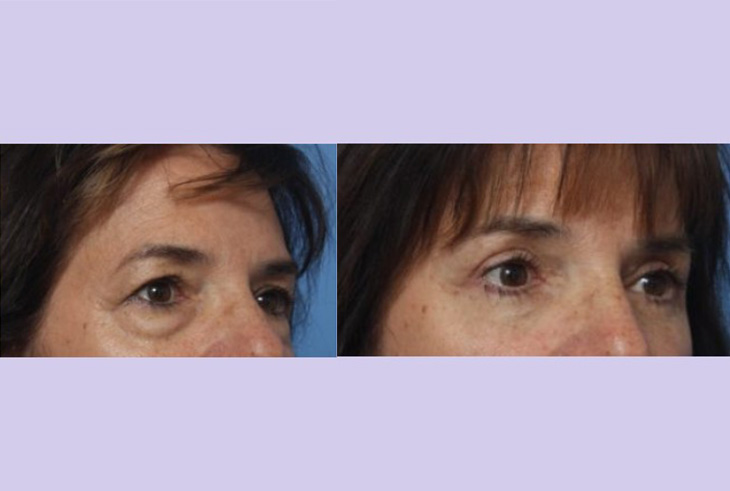 Before and After Image: Upper and Lower Blepharoplasty – Case 39 - right-front-oblique