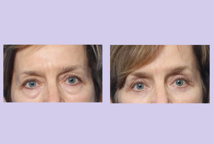 Before and After Image: Upper and Lower Blepharoplasty – Case 40 - front