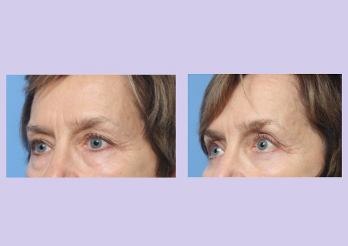 Before and After Image: Upper and Lower Blepharoplasty – Case 40 - left-front-oblique