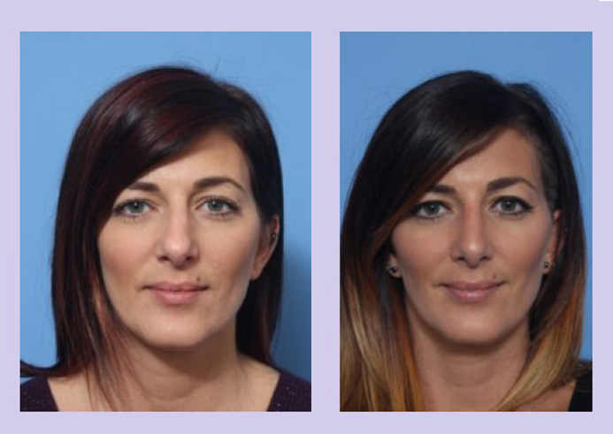 Before and After Image: Rhinoplasty – Case 9 - front