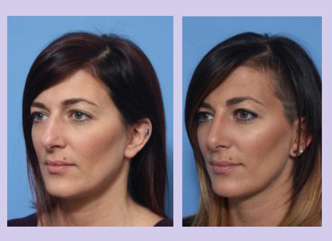 Before and After Image: Rhinoplasty – Case 9 - left-front-oblique