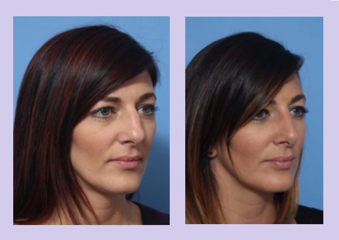 Before and After Image: Rhinoplasty – Case 9 - right-front-oblique
