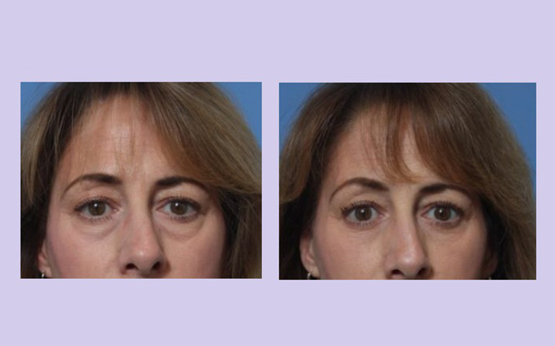 Before and After Image: Lower Blepharoplasty – Case 41 - front