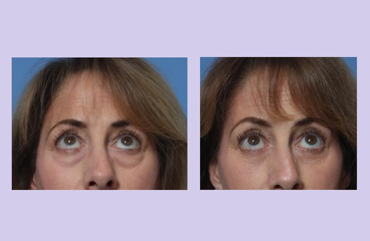 Before and After Image: Lower Blepharoplasty – Case 41 - front