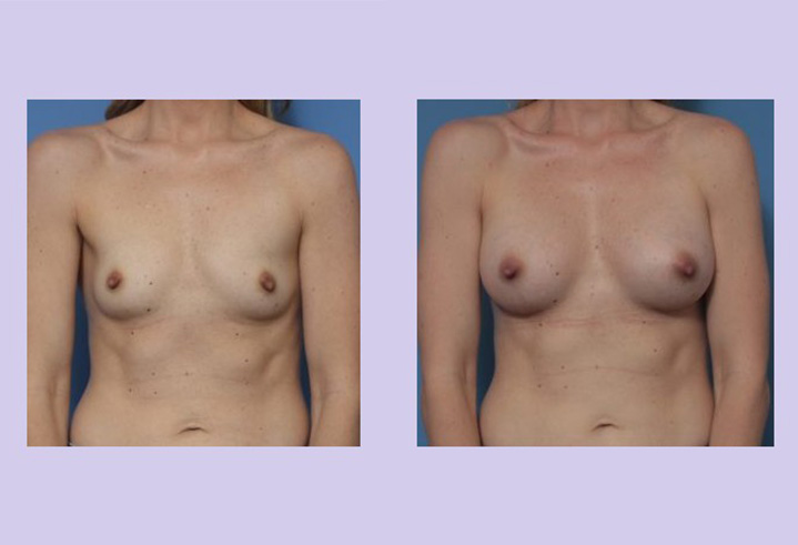 Before and After Image: Breast Augmentation – Case 38