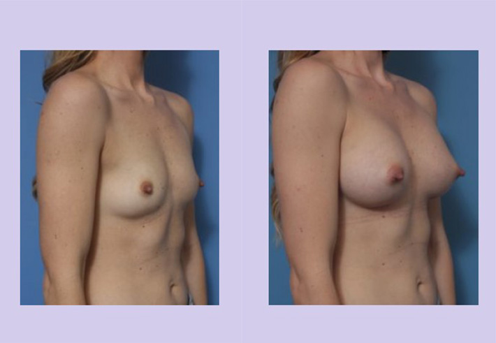 Before and After Image: Breast Augmentation – Case 38 - right-front-oblique