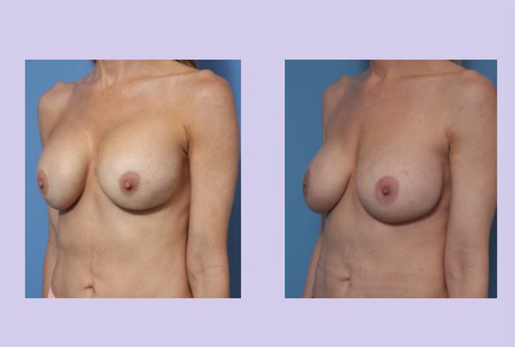 Before and After Image: Breast Correction – Case 23 - left-front-oblique