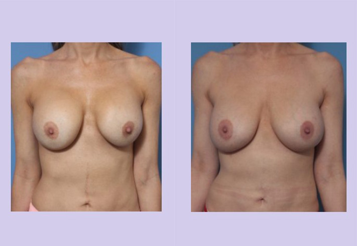 Before and After Image: Breast Correction – Case 23