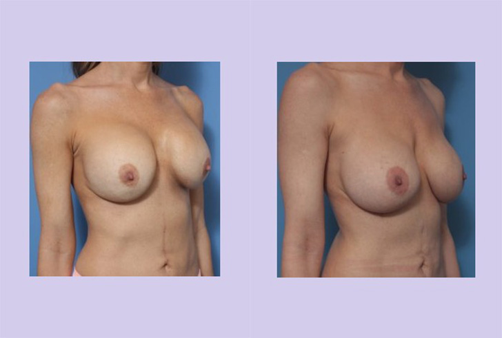 Before and After Image: Breast Correction – Case 23 - right-front-oblique