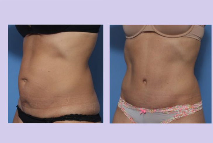 Before and After Image: Abdominoplasty – Tummy Tuck – Case 36 - left-front-oblique