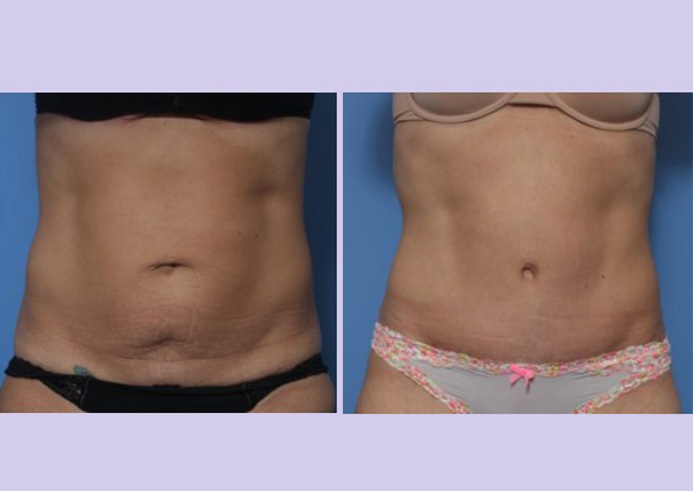 Before and After Image: Abdominoplasty – Tummy Tuck – Case 36 - front