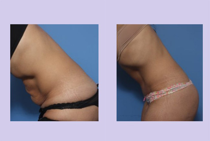 Before and After Image: Abdominoplasty – Tummy Tuck – Case 36 - left-side