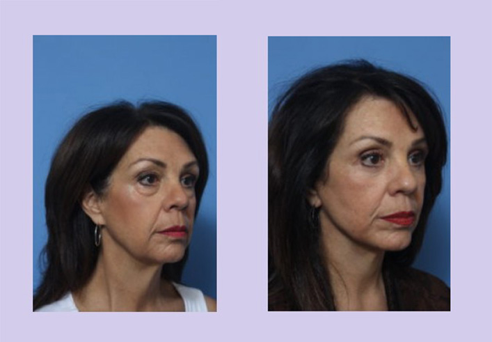Before and After Image: Lower Facelift – Case 24 - right-front-oblique