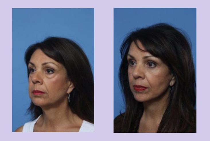 Before and After Image: Lower Facelift – Case 24 - left-front-oblique