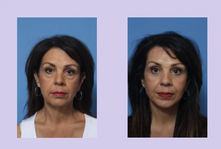 Before and After Image: Lower Facelift – Case 24 - front