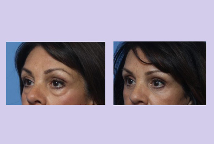 Before and After Image: Upper and Lower Blepharoplasty – Case 42 - left-front-oblique