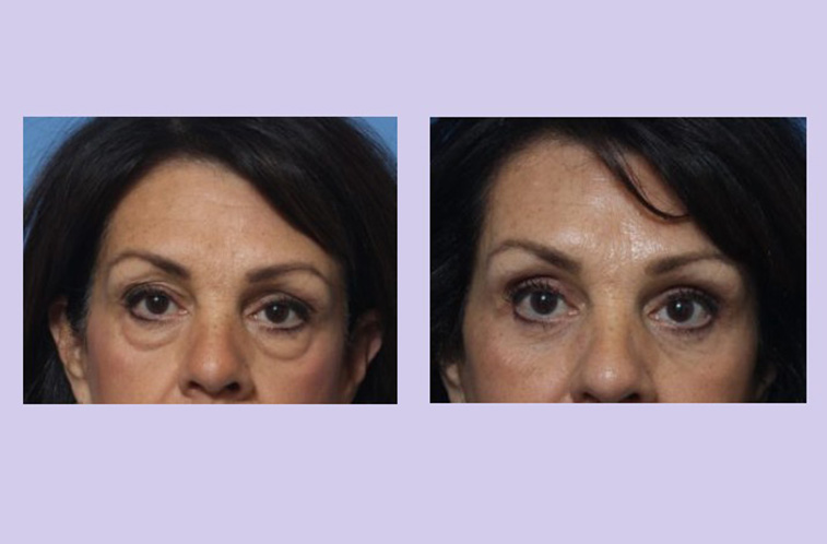 Before and After Image: Upper and Lower Blepharoplasty – Case 42 - front
