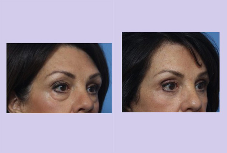 Before and After Image: Upper and Lower Blepharoplasty – Case 42 - right-front-oblique