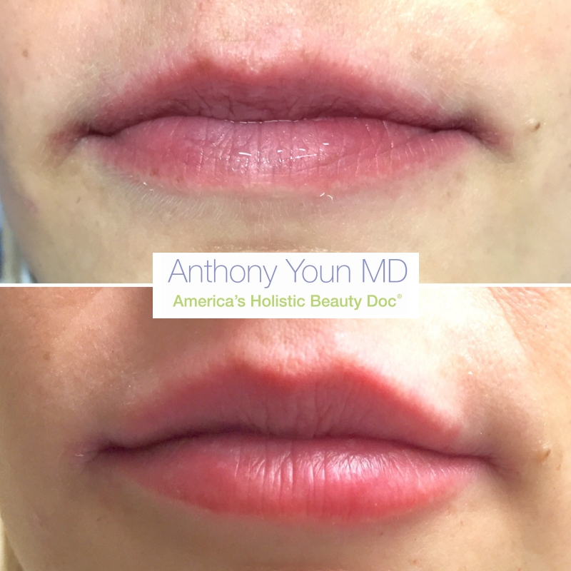 Lips Before and After