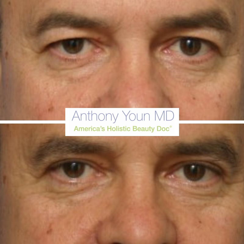 Upper Blepharoplasty