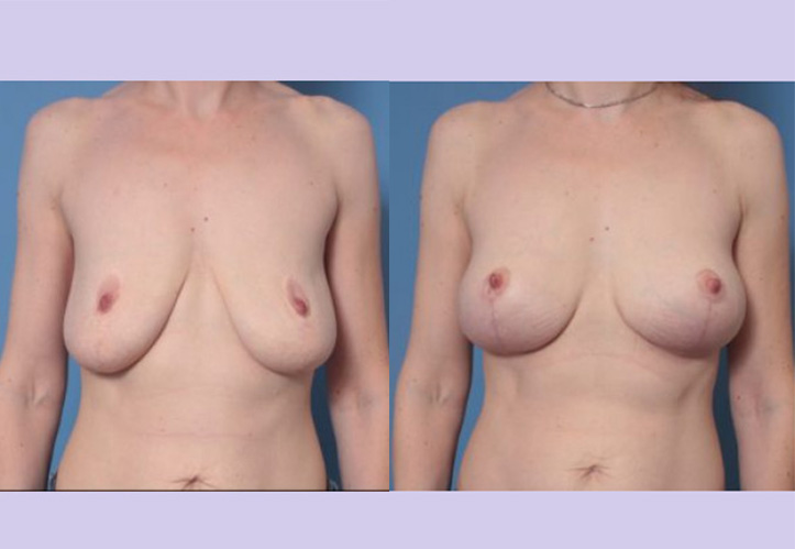 Before and After Image: Breast Lift – Case 24 - front