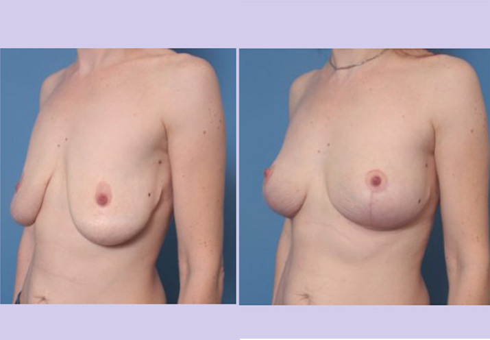 Before and After Image: Breast Lift – Case 24 - left-front-oblique