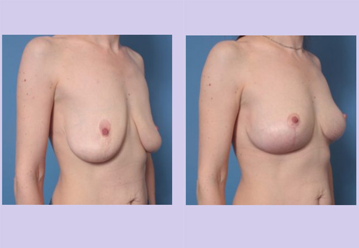 Before and After Image: Breast Lift – Case 24 - right-front-oblique