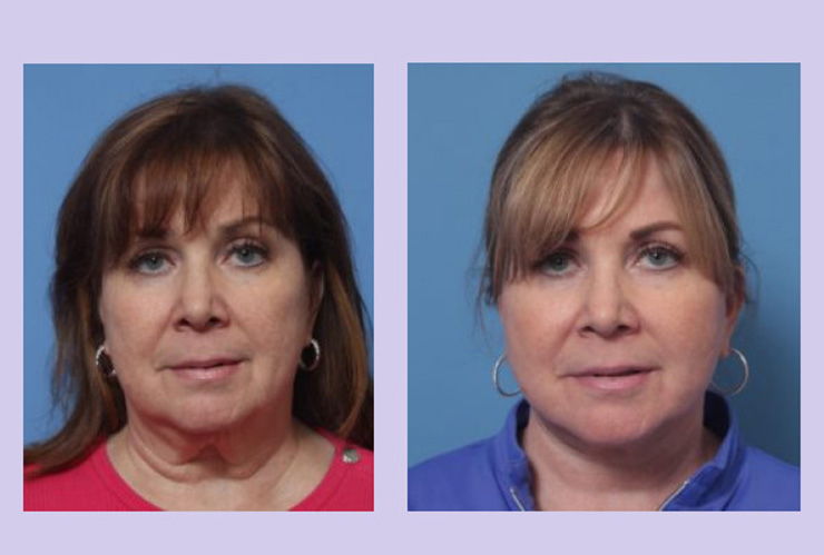 Before and After Image: Lower Facelift – Case 25 - front