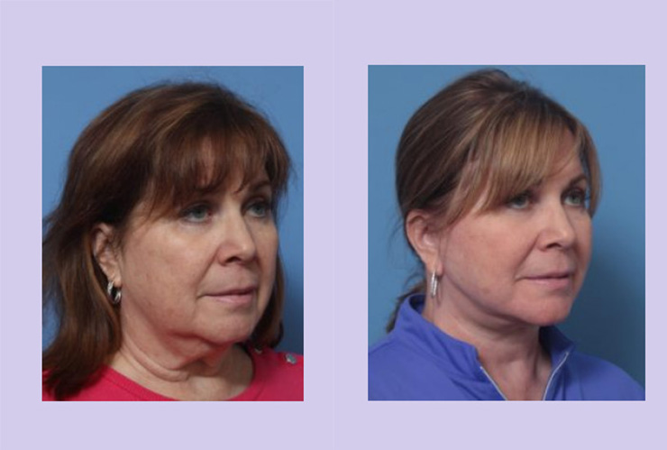 Before and After Image: Lower Facelift – Case 25 - right-front-oblique